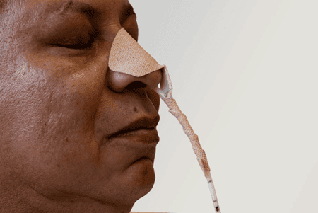 Dale NasoGastric Tube Holders - Image 3
