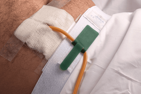 Dale Hold-n-Place Foley Catheter Holders - Image 3